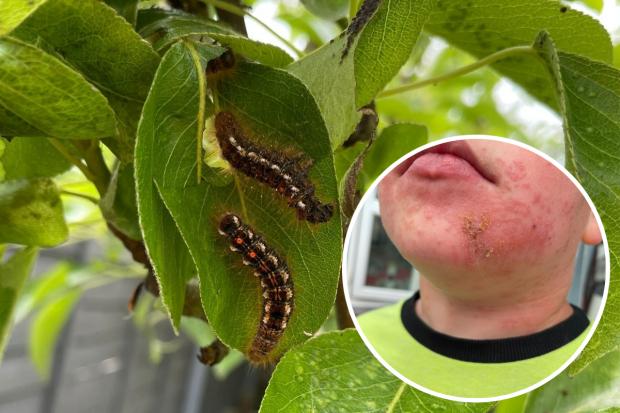 Four-year old Oliver was left with a painful rash after touching a caterpillar in his garden. Picture: Caroline Gel