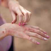 What is contact dermatitis? The NHS explains symptoms and when to see a doctor or pharmacist